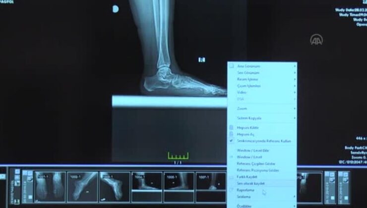 literatürde tanımlanmamış ‘üçlü ayak deformitesi’ hastaları için özel tabanlık tasarlandı