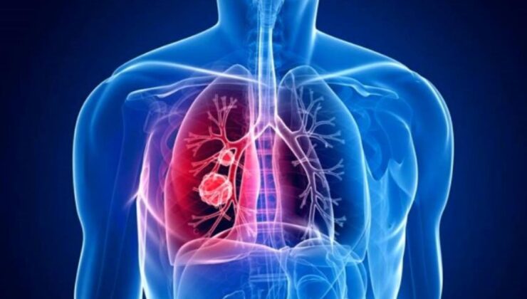 akciğer kanseri belirtileri nelerdir? akciğer kanseri ilk evre belirtileri! akciğer kanseri 4 evre ölüm belirtileri nedir?
